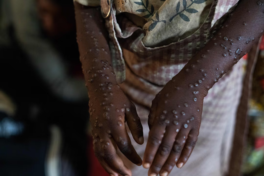 2024-09-22
Mpox 猴痘 傳播迅速：⁠ 每個人都應該擔心 ...